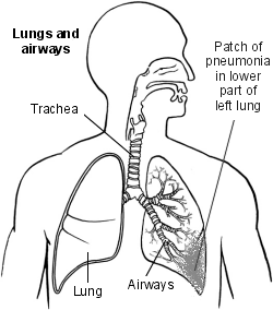 Lungs showing patch of pneumonia